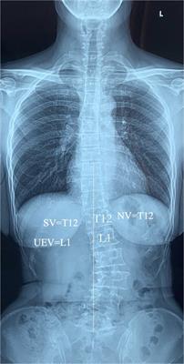 Reliability of end, stable, neutral, first coronal reverse vertebrae identification in degenerative lumbar scoliosis: Intra- and interobserver consistency analysis